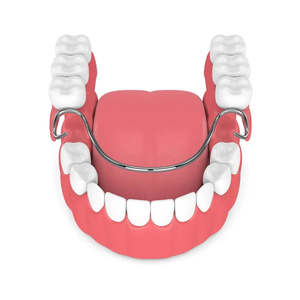 Візуалізація Знімного Часткового Зубного Ряду Ізольовано Білому Тлі — стокове фото