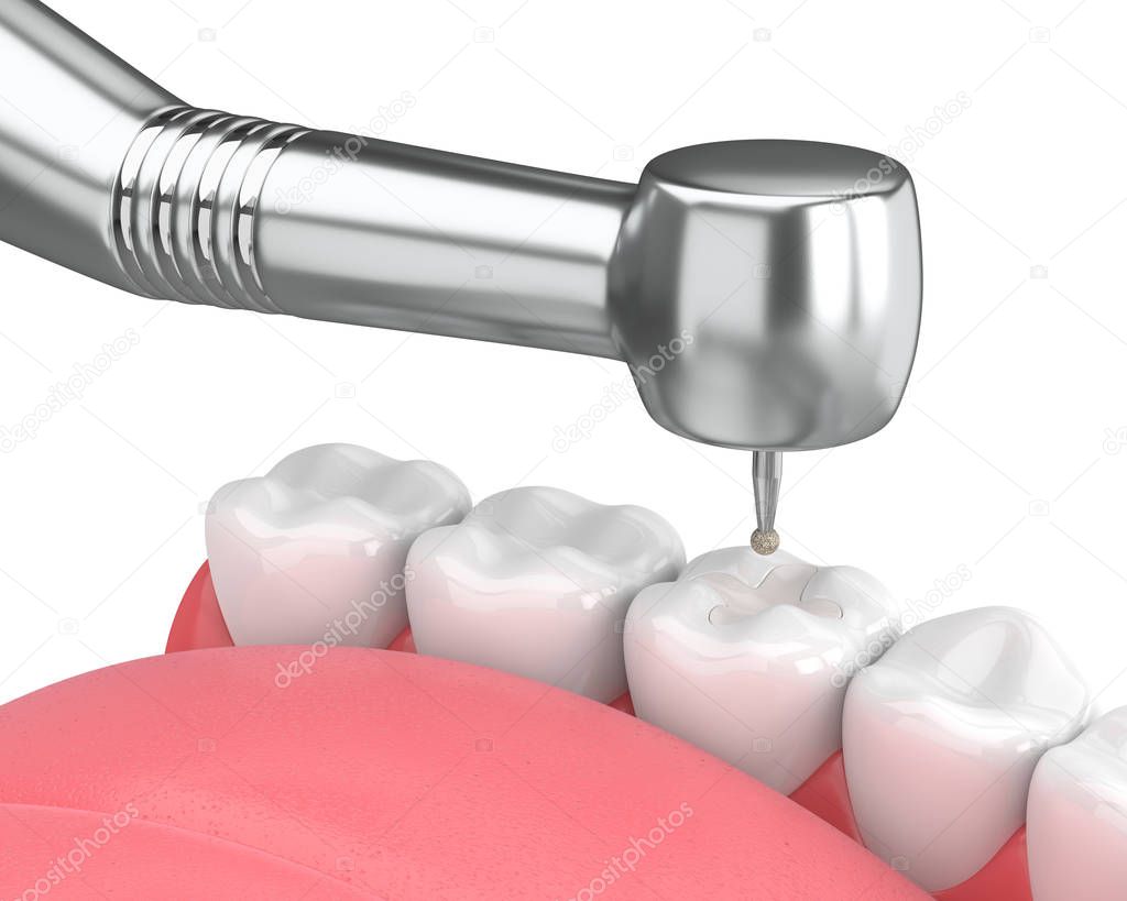3d render of jaw with dental handpiece and drill isolated over white