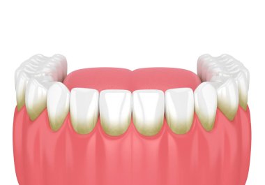 3d render of teeth with plaque and tartar over white background clipart