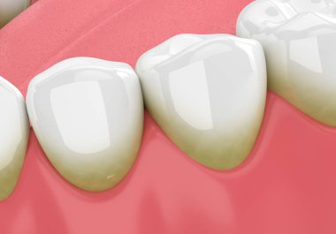 3d render of teeth with plaque and tartar over white background clipart