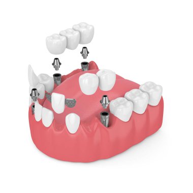 3d render of jaw with dental implants and bridges over white background clipart