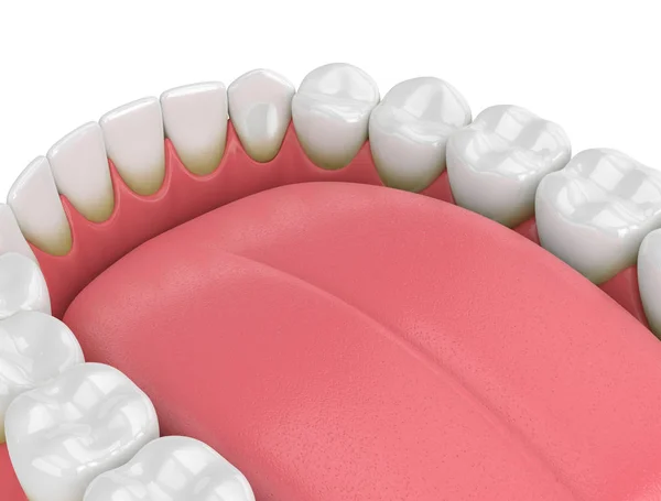 Rendering Denti Con Placca Tartaro Sfondo Bianco — Foto Stock