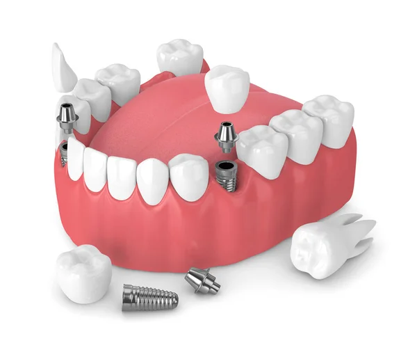 Візуалізація Щелепи Зубними Імплантатами Мостами Білому Тлі — стокове фото