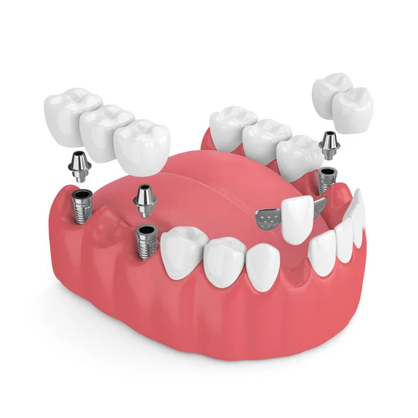çene dental implantlar ve köprüleri ile 3D render