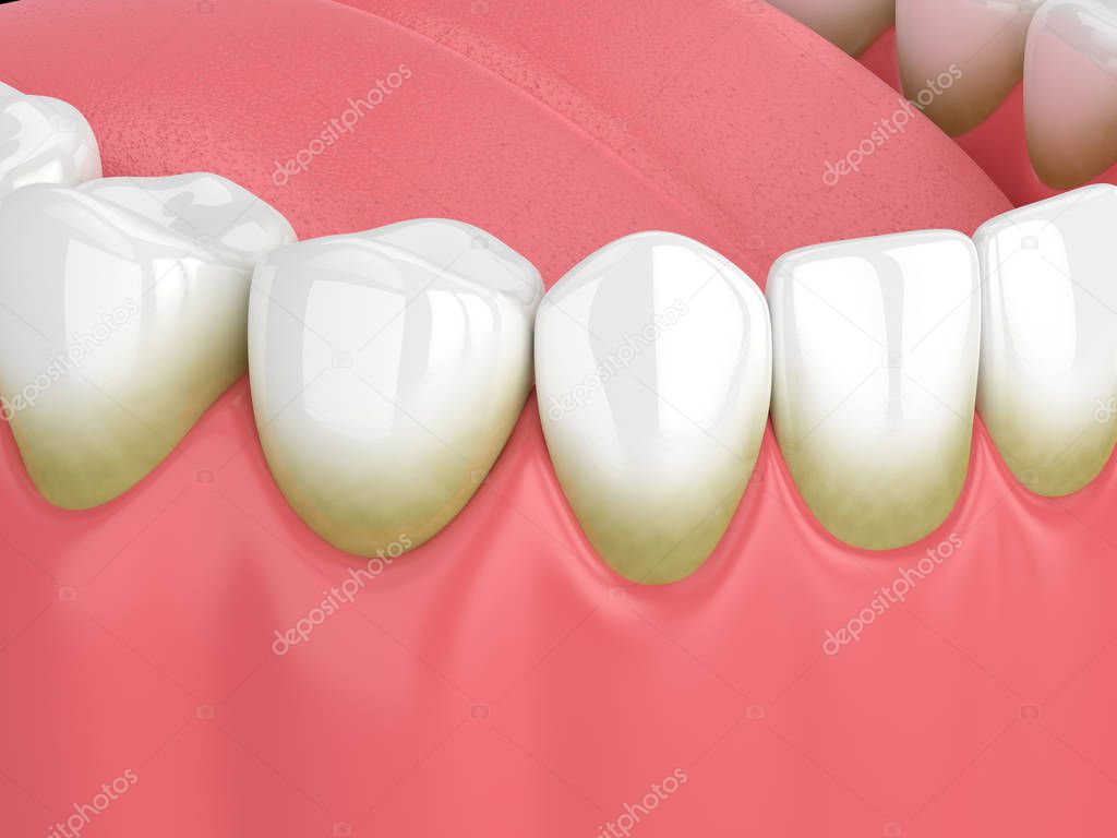 3d render of teeth with plaque and tartar over white background