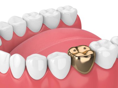 3d render of teeth  in gums with golden dental crown restoration over white background clipart