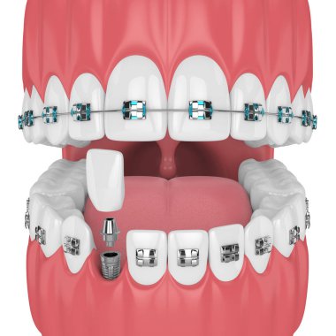 3d render of teeth with orthodontic braces and dental implant. Orthodontic braces concept clipart