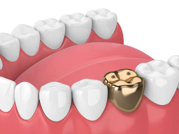 3d render of teeth  in gums with golden dental crown restoration over white background