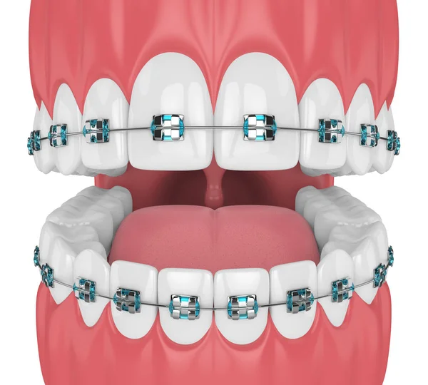 Render Van Kaak Met Tanden Orthodontische Accolades Geïsoleerd Witte Achtergrond — Stockfoto