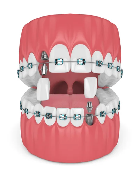 Рендеринг Зубов Ортодонтическими Брекетами Зубными Имплантатами Концепция Ортодонтических Скобок — стоковое фото
