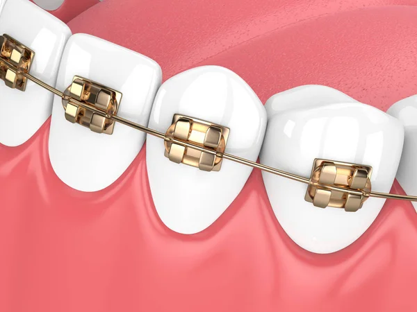 Візуалізація Щелепи Зубами Золотими Ортодонтичними Брекетами Ізольовані Білому Тлі — стокове фото