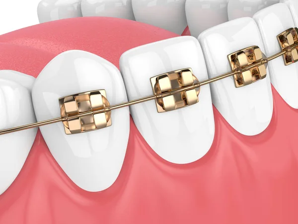 Render Jaw Teeth Golden Orthodontic Braces Isolated White Background — Stock Photo, Image