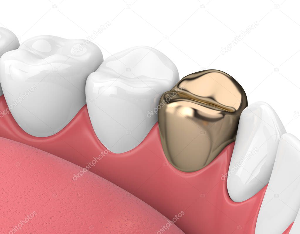 3d render of teeth  in gums with golden dental crown over white background