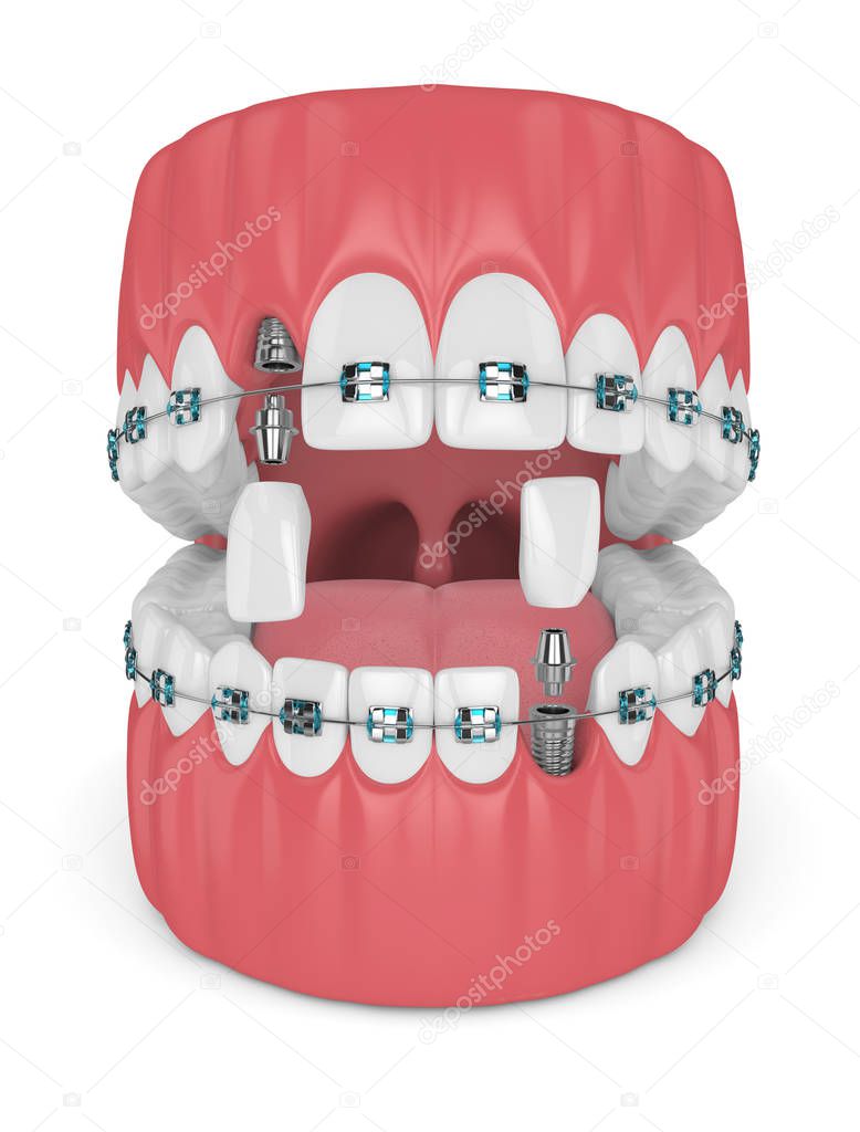 3d render of teeth with orthodontic braces and dental implants. Orthodontic braces concept