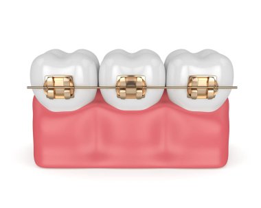 Diş beyaz arka plan üzerinde izole altın ortodontik diş telleri ile 3D render