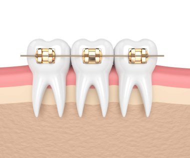3d render of teeth with golden orthodontic braces isolated over white background clipart