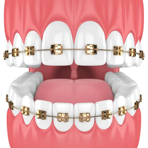 Візуалізація Щелепи Зубами Золотими Ортодонтичними Брекетами Ізольовані Білому Тлі — стокове фото
