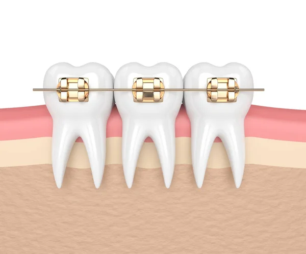 白い背景に分離された黄金の矯正ブレースを有する歯の レンダリング — ストック写真