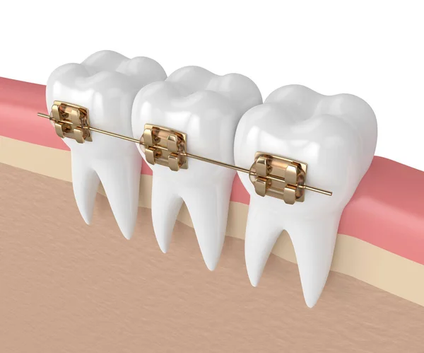 Render Teeth Golden Orthodontic Braces Isolated White Background — Stock Photo, Image