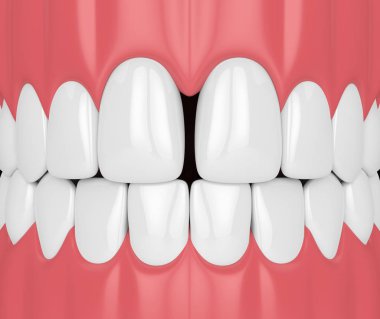 Diş diastema ile 3D render. Diş disfunctions kavramı.