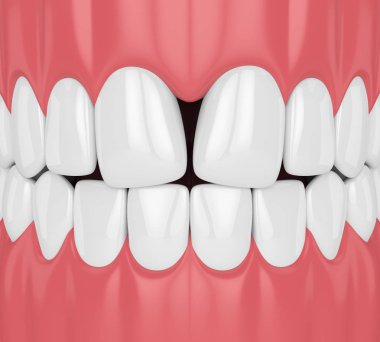 Diş yakınsak diastema ile 3D render 