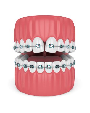 3D render diş yakınsak diastema ve beyaz arka plan üzerinde diş teli ile. Iraksak diastema düzeltme kavramı. 