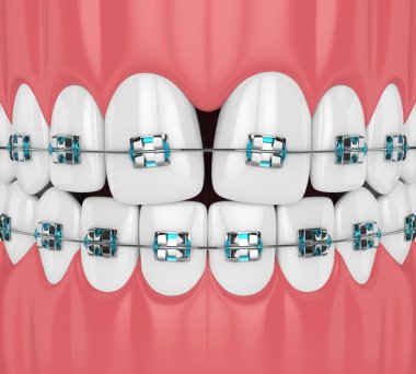 3D render diş yakınsak diastema ve diş teli ile. Iraksak diastema düzeltme kavramı. 