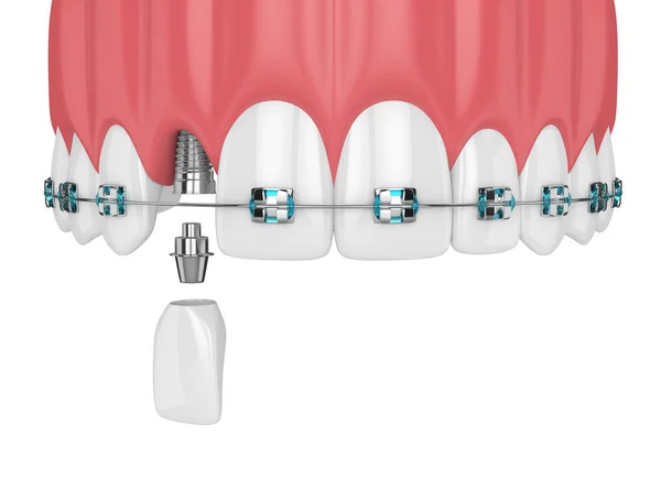 Render Tänder Med Tandreglering Hängslen Och Tandimplantat Tandreglering Tandställning Konceptet — Stockfoto