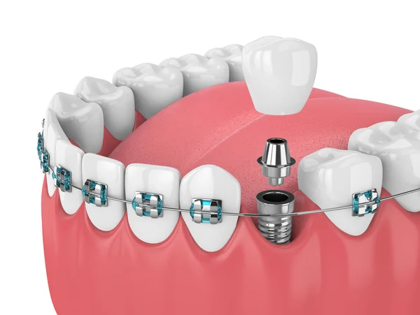 Renderizado Dientes Con Ortodoncia Implantes Dentales Concepto Ortodoncia —  Fotos de Stock