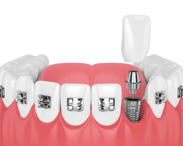 Vykreslování Zubů Ortodontické Rovnátka Zubní Implantát Koncept Ortodontická Rovnátka — Stock fotografie