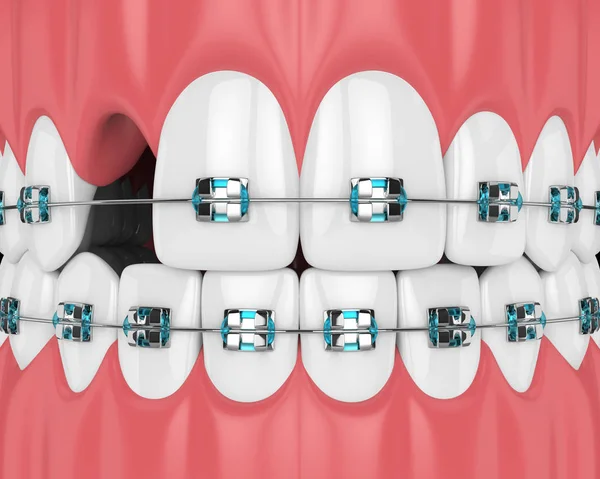 Vykreslování Zubů Rovnátky Dutiny Zubní Ošetření Koncept — Stock fotografie