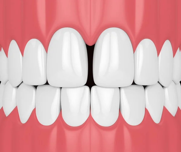 Renderizado Dientes Con Diastema Concepto Disfunciones Dentales —  Fotos de Stock