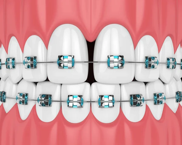 Renderização Dentes Com Diastema Aparelho Conceito Correção Diastema — Fotografia de Stock