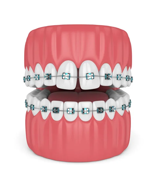 Render Teeth Divergent Diastema Braces White Background Divergent Diastema Correction — Stock Photo, Image