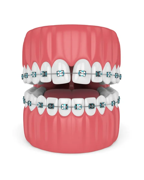 Render Teeth Convergent Diastema Braces White Background Divergent Diastema Correction — Stock Photo, Image