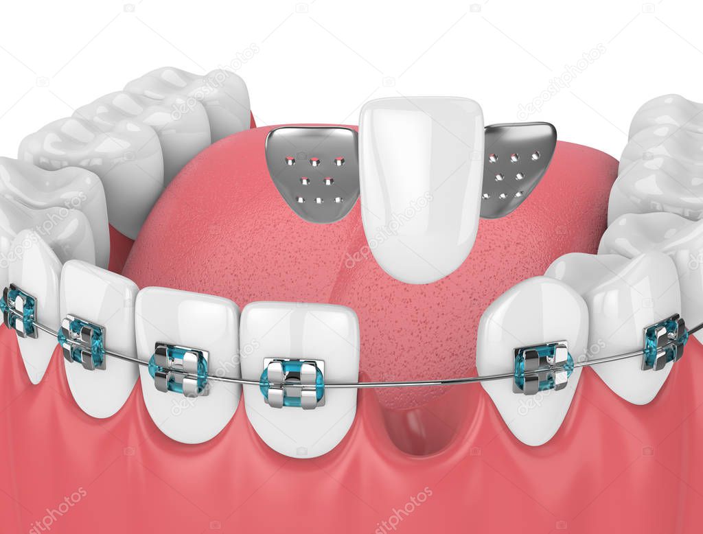 3d render of teeth with orthodontic braces and dental maryland bridge. Orthodontic braces concept