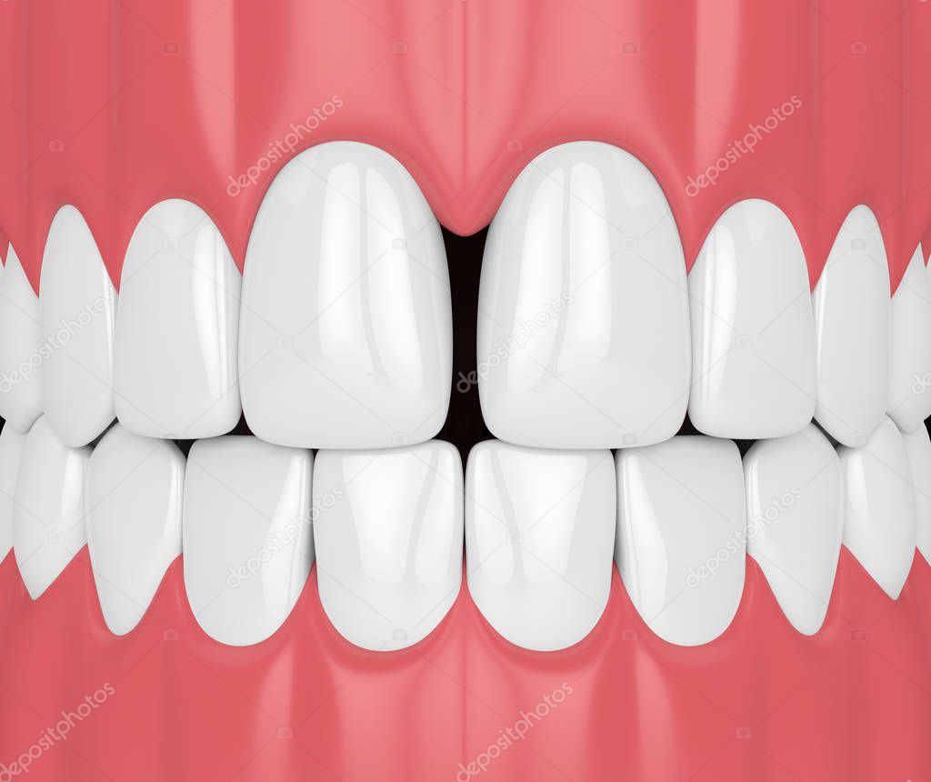 3d render of teeth with diastema. Dental disfunctions concept.