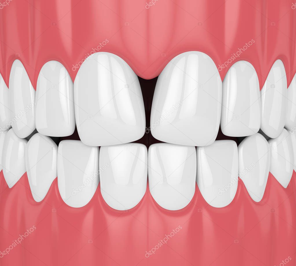 3d rendering of teeth with convergent diastema 