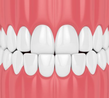 çene maloklüzyon underbite ile 3D render. Üst dişler alt dişleri arkasında