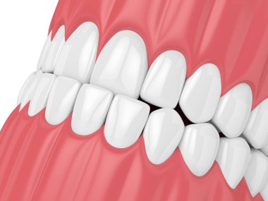 çene maloklüzyon underbite ile 3D render. Üst dişler alt dişleri arkasında