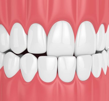 çene maloklüzyon underbite ile 3D render. Üst dişler alt dişleri arkasında
