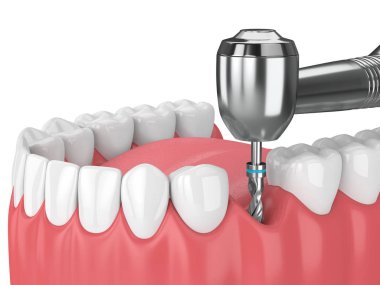 çene dental implant matkap ile 3D render. İmplantasyon işlem kavramı.