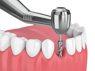 çene dental implant matkap ile 3D render. İmplantasyon işlem kavramı.