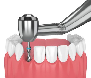 çene dental implant matkap ile 3D render. İmplantasyon işlem kavramı.