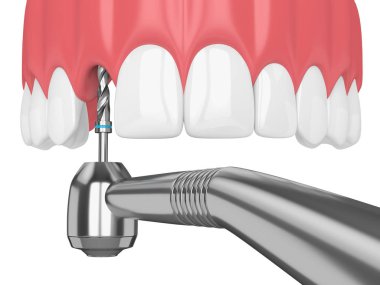 çene dental implant matkap ile 3D render. İmplantasyon işlem kavramı.