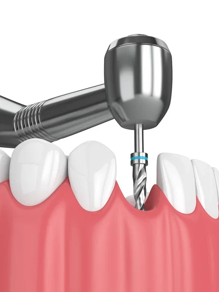 Renderizado Mandíbula Con Taladro Implante Dental Concepto Proceso Implantación — Foto de Stock