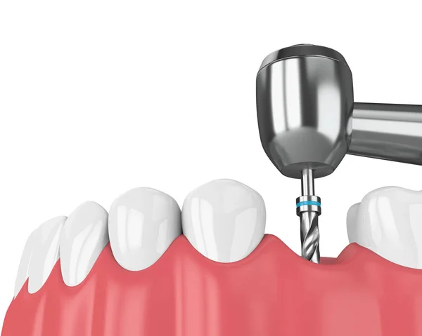 Renderizado Mandíbula Con Taladro Implante Dental Concepto Proceso Implantación — Foto de Stock