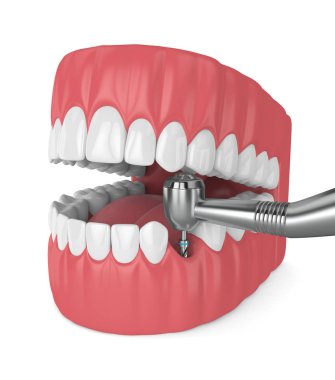çene dental implant matkap ile 3D render. İmplantasyon işlem kavramı.