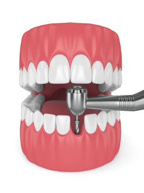 çene dental implant matkap ile 3D render. İmplantasyon işlem kavramı.