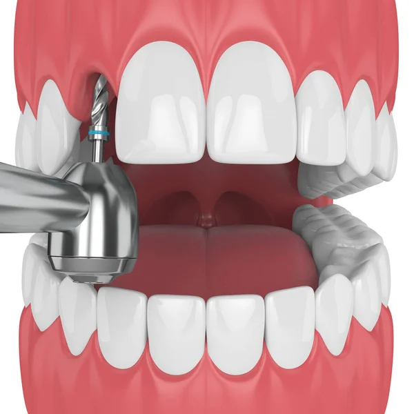 Render Állkapocs Fúróval Fogászati Implantátum Implantáció Folyamat Fogalma — Stock Fotó